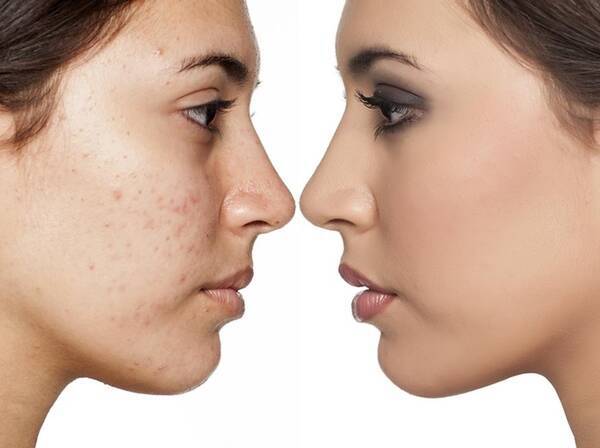 ニキビを自然に隠すメイクテクが目からウロコ カギは意外なアイテム 19年5月9日 エキサイトニュース