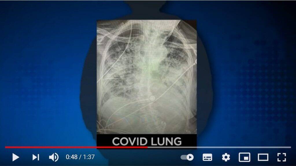 新型コロナウイルス感染後の肺と喫煙者の肺を比較したレントゲン写真 自分の目で見ないと事態がどれだけ深刻か理解できない人が多すぎる いまだに ただの風邪でしょ って言ってる人いるもんな 21年1月17日 エキサイトニュース