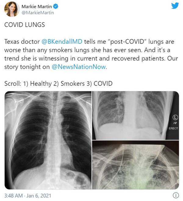 新型コロナウイルス感染後の肺と喫煙者の肺を比較したレントゲン写真 自分の目で見ないと事態がどれだけ深刻か理解できない人が多すぎる いまだに ただの風邪でしょ って言ってる人いるもんな 21年1月17日 エキサイトニュース