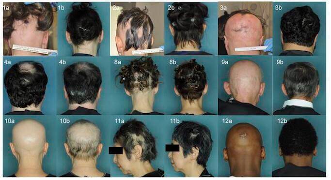 円形脱毛症に特効薬か 数か月で90 以上の毛髪を回復させた薬が発見される 16年10月2日 エキサイトニュース