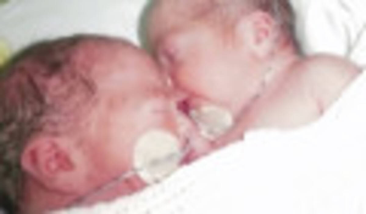 頭蓋骨がつながっている双子の赤ちゃん 16時間にも及ぶ手術の結果 分離手術に成功 16年10月29日 エキサイトニュース