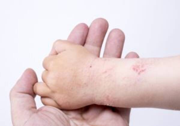乳酸菌で アトピー性皮膚炎 が改善 アレルギー予防には 小腸の免疫アップ 16年4月24日 エキサイトニュース