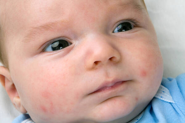 乳児湿疹に薬は不要だった 湿疹には ワセリン を塗りたい理由 16年2月21日 エキサイトニュース