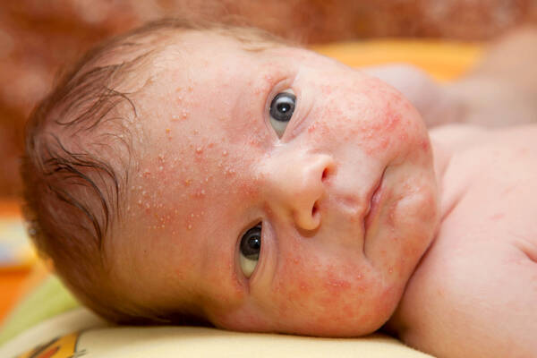 乳児湿疹 可愛いはずの顔がボロボロ 看護師が教える 基本ケア 17年7月16日 エキサイトニュース