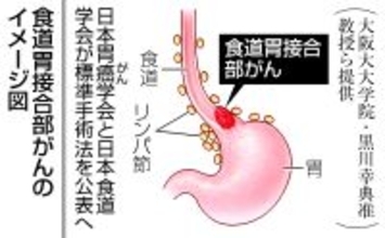 食道胃接合部がんに標準手術法＝３６０例分析、２学会が公表へ
