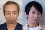 「《「ハゲ」「キモい」と言われ…》いしだ壱成　薄毛で芸能界引退、うつ・離婚も…植毛で取り戻した自信「ここからが第二の人生」」の画像1