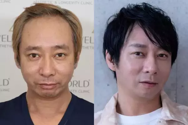 《「ハゲ」「キモい」と言われ…》いしだ壱成　薄毛で芸能界引退、うつ・離婚も…植毛で取り戻した自信「ここからが第二の人生」
