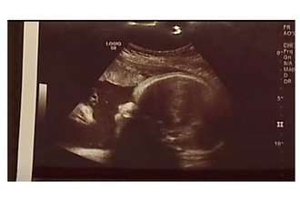 胎児エコー写真に写っていた驚きのモノとは？