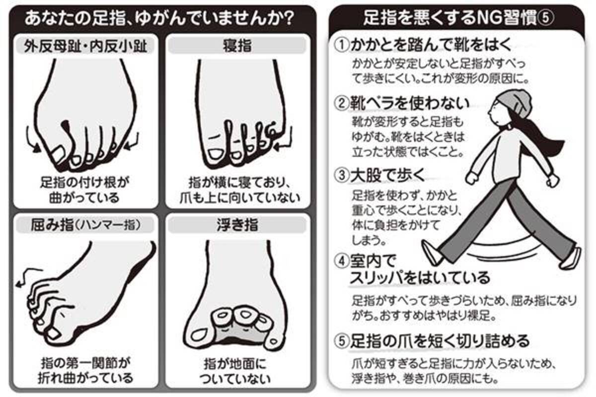 あなたの足指は大丈夫 日本人が起こしやすい足指の変形症状 17年11月6日 エキサイトニュース