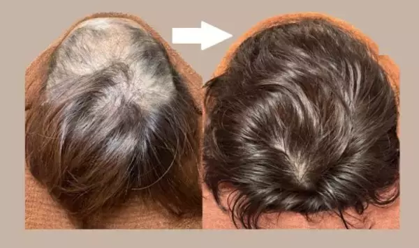 このままじゃ髪がヤバい！薄毛やパサパサ髪はよみがえるのか？人気沸騰の「育毛鍼灸師」に聞きました