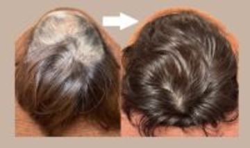 このままじゃ髪がヤバい！薄毛やパサパサ髪はよみがえるのか？人気沸騰の「育毛鍼灸師」に聞きました