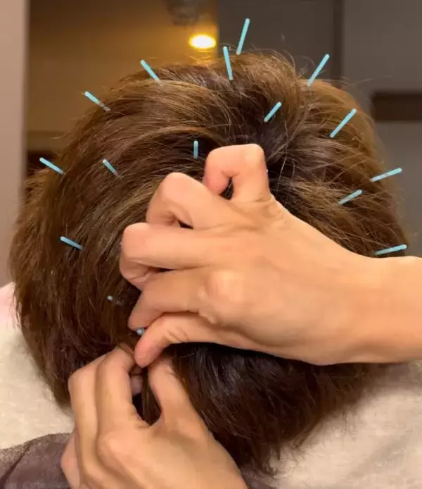 「このままじゃ髪がヤバい！薄毛やパサパサ髪はよみがえるのか？人気沸騰の「育毛鍼灸師」に聞きました」の画像