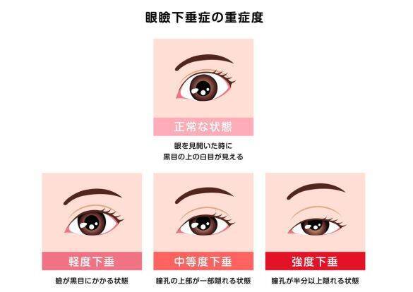 年齢とともに目が小さくなって…。まぶたが垂れてくる問題をどうする？根本解決から簡単テクまで