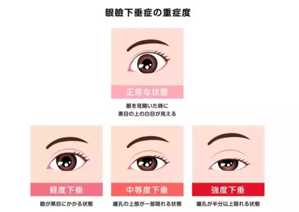 「年齢とともに目が小さくなって…。まぶたが垂れてくる問題をどうする？根本解決から簡単テクまで」の画像