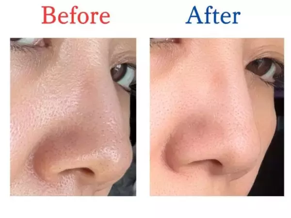 「40代、頑固な毛穴の黒ずみ・角栓が…“1,100円”でスッキリ！ 洗顔前の“あったか毛穴ケア”がコスパ抜群」の画像