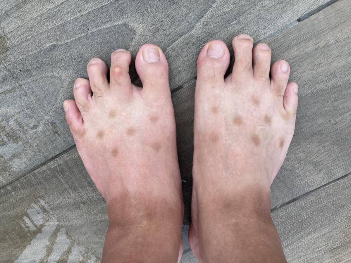 足に浮かび上がった 謎の斑点 病気かと思って怯えていたら 犯人はまさかの アレ だった 年9月14日 エキサイトニュース 足に浮かび上がった 謎の斑点 病気かと思って怯えていたら 犯人はまさかの アレ だった 年9月14日 エキサイトニュース