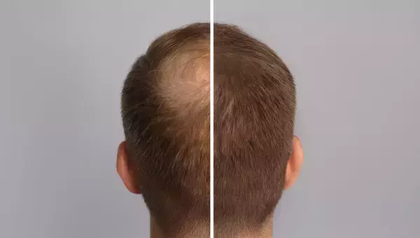 失われた毛が再び生えてくる。幹細胞から毛根組織を再生に成功（日本研究）