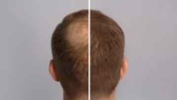 失われた毛が再び生えてくる。幹細胞から毛根組織を再生に成功（日本研究）