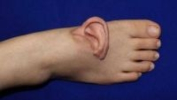 自身の耳を足に移植して保存し、再び耳に戻す手術に成功（中国）