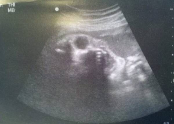 何か別のものを宿しちゃったみたい 胎児以外の何かに見えてくる恐怖の超音波画像 16年8月15日 エキサイトニュース