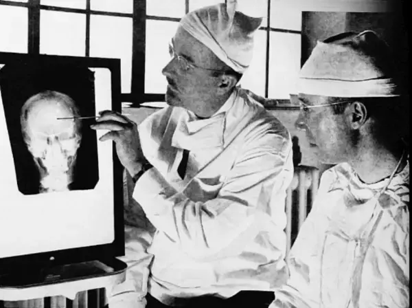 かつて精神疾患の治療法として用いられたロボトミー手術を受けた患者のビフォア・アフター写真（1940年代）