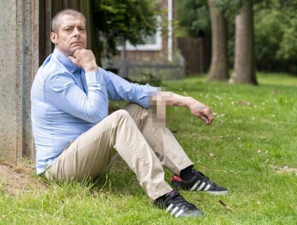 大切なイチモツを失った男性 腕に人工イチモツを生やして4年 移植手術を待ち続ける イギリス 年8月4日 エキサイトニュース