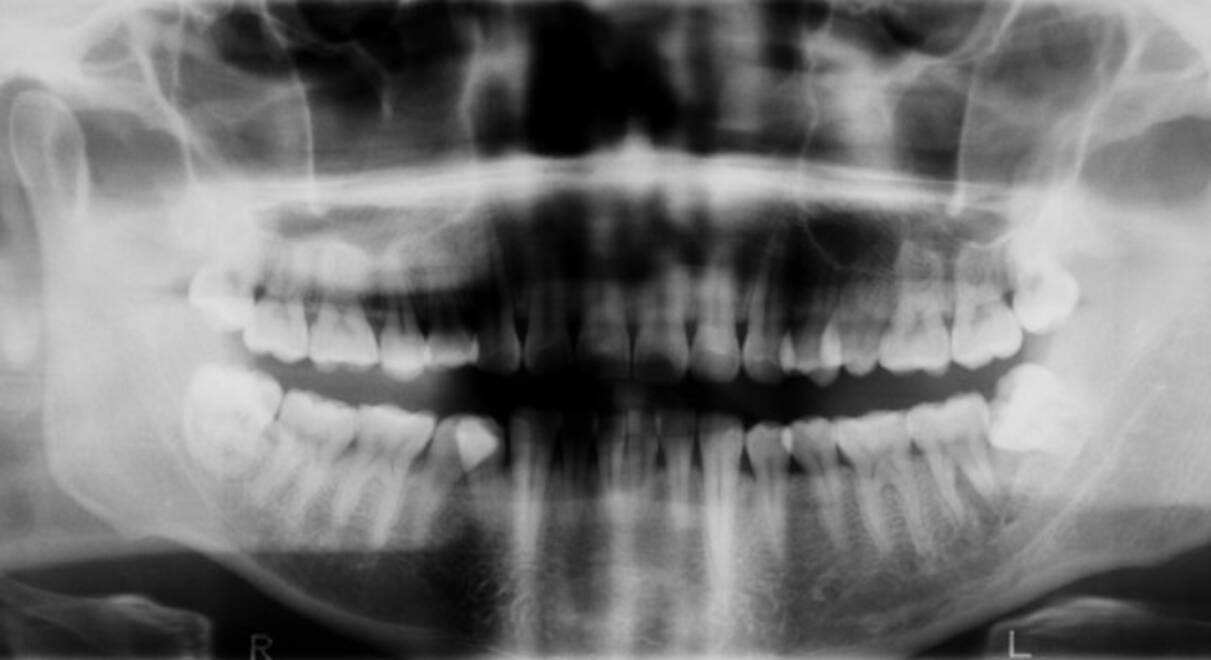 骨が崩れ顎がなくなる 放射性物質が入ったエナジードリンクを飲んだ男性の末路 21年2月11日 エキサイトニュース