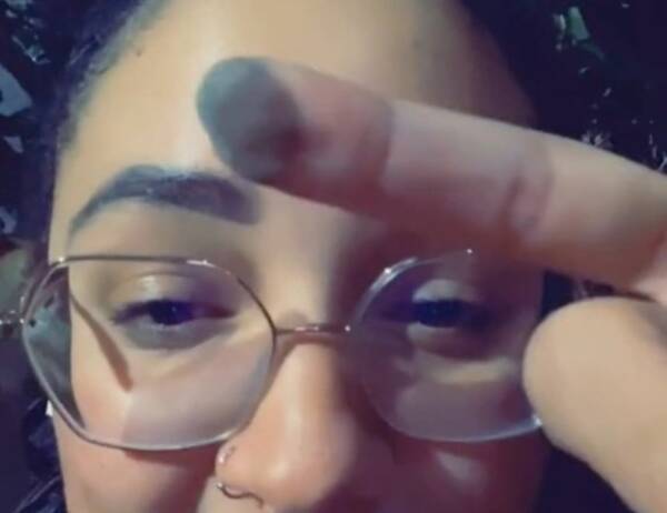 ビキニラインから指へ皮膚移植した女性 指からアンダーヘアが生えてきたことを報告 アメリカ 21年2月16日 エキサイトニュース