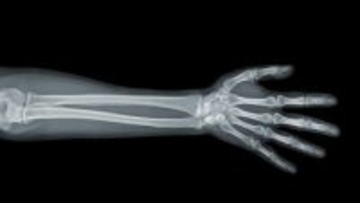 AI生成の偽のレントゲン写真、医師ですら見抜くのが難しいことが明らかに