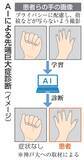 「手の写真で難病をAI診断　プライバシー配慮、神戸大チーム」の画像1