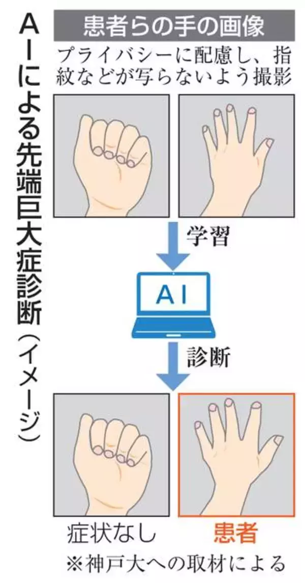 手の写真で難病をAI診断　プライバシー配慮、神戸大チーム