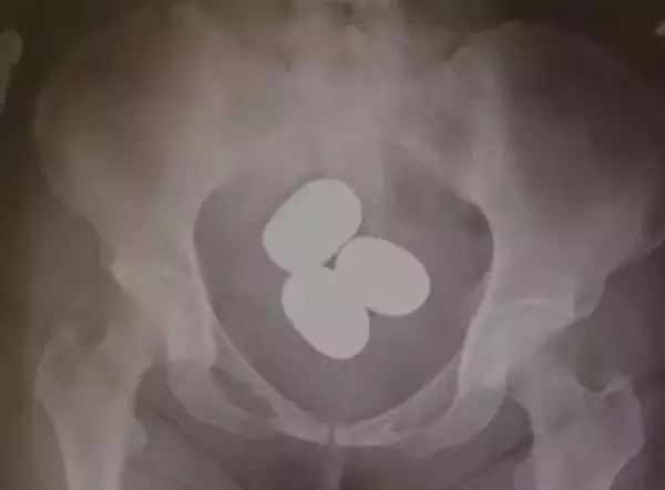 体内に隠す金の密輸が急増　香港から成田へ、12億円分押収