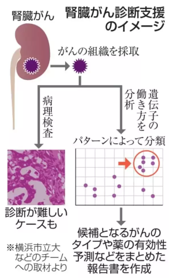 遺伝子働き方で腎臓がん分類　横浜市立大、診断支援法開発