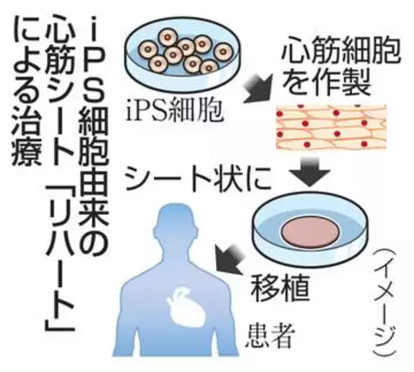 iPS心筋シートに保険適用　2例目、心不全治療