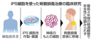 脊髄iPS移植、副作用なし　慶応大、最長4年観察