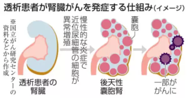 透析特有の腎臓がん解明　炎症で異常増殖、治療期待
