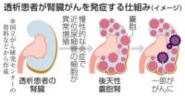 透析特有の腎臓がん解明　炎症で異常増殖、治療期待