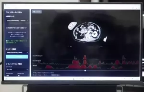 けがCT画像、10秒でAI分析　的確に「止血」、迅速な治療期待