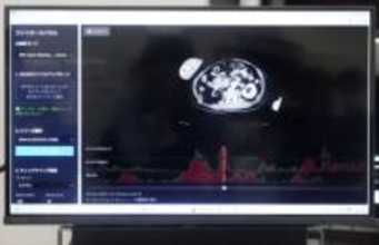 けがCT画像、10秒でAI分析　的確に「止血」、迅速な治療期待