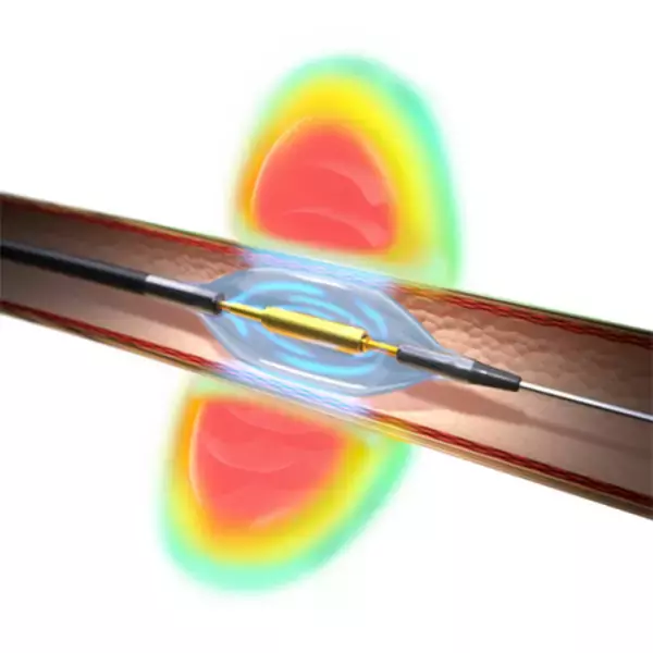 「大塚メディカルデバイス/大塚製薬：Paradise 超音波式腎デナベーションシステム 治療抵抗性高血圧症を適応症に保険適用、販売開始」の画像