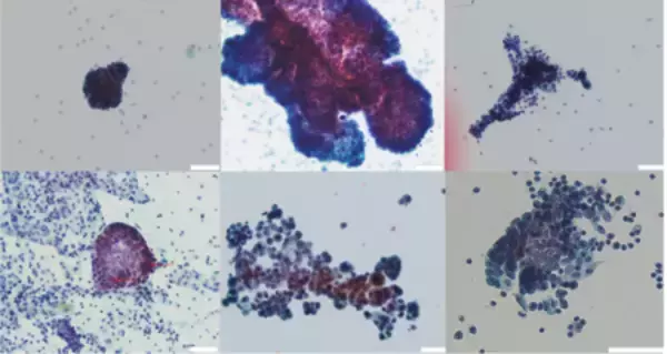 「卵巣癌の急速な腹膜播種形成のメカニズムを発見！」の画像
