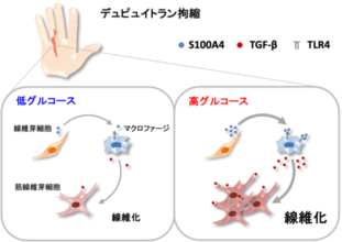 糖尿病患者に多いデュピュイトラン拘縮の新たな線維化メカニズムを解明