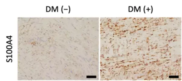 「糖尿病患者に多いデュピュイトラン拘縮の新たな線維化メカニズムを解明」の画像