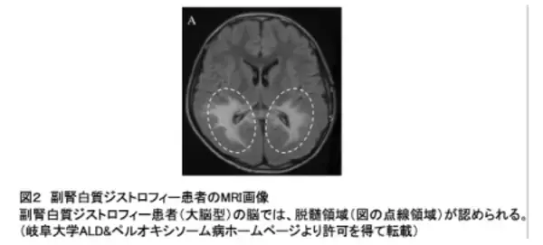 「指定難病「副腎白質ジストロフィー」診断の鍵となる マーカー分子の産生酵素を発見」の画像