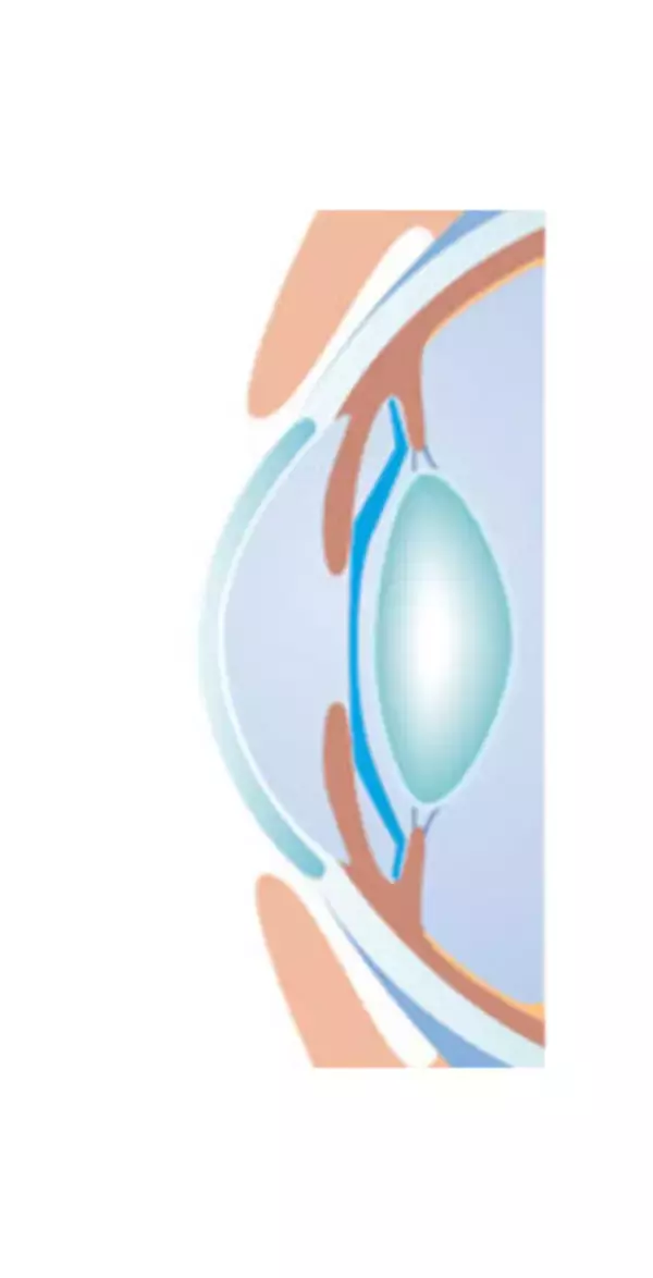 「【ICL Newsletter】花粉シーズンに考える「目の健康」と視力矯正」の画像