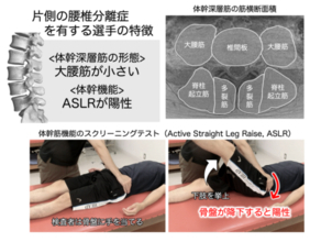 MRIと簡便な体幹筋機能のスクリーニングで“腰椎分離症”の特徴を解明