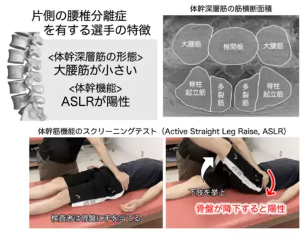 MRIと簡便な体幹筋機能のスクリーニングで“腰椎分離症”の特徴を解明