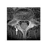 「MRIと簡便な体幹筋機能のスクリーニングで“腰椎分離症”の特徴を解明」の画像2