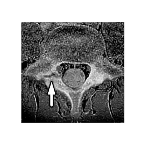 「MRIと簡便な体幹筋機能のスクリーニングで“腰椎分離症”の特徴を解明」の画像