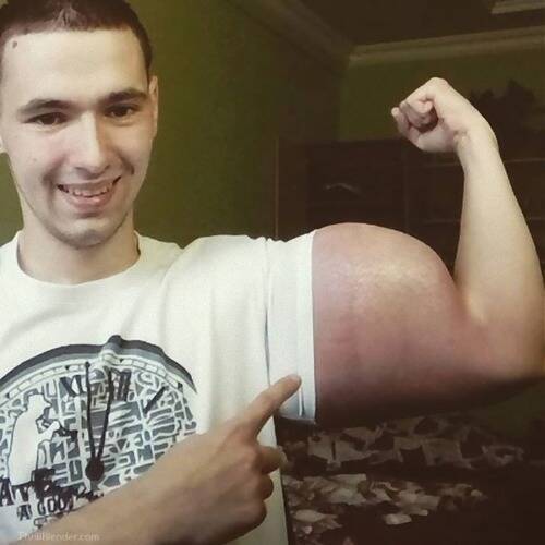 ロシア男性 筋トレは嫌いだけど太い腕が欲しい 注射で 偽の筋肉 をゲットするも批判殺到 17年11月27日 エキサイトニュース